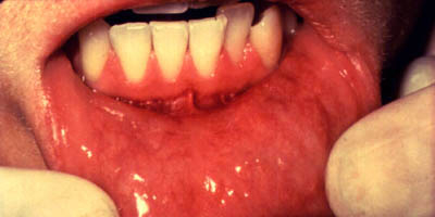 Rakovina dutiny ústní