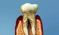 Parodontóza - skrytý strašák v ústech