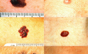 Zhoubný melanom kůže je daň za opálenou kůži