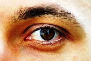 Chronické příznaky syndromu suchého oka
