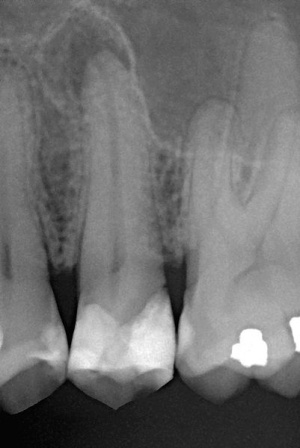 Zánět dásní a parodontóza
