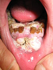 Rakovina v dutině ústní