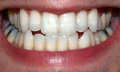 Zánět okostice zubu a zánět dásní